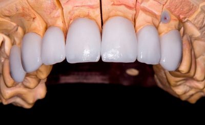 Faccette dentali: cosa sono e come funzionano