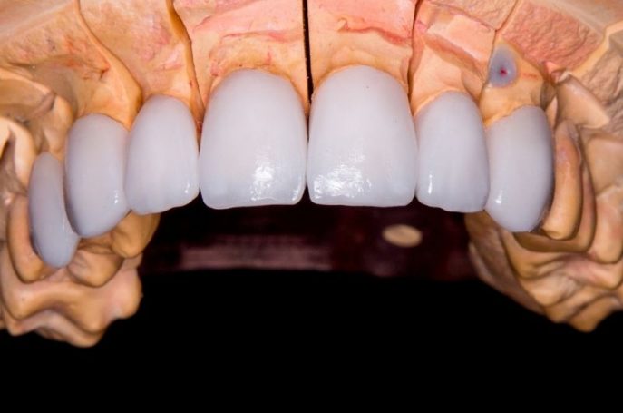 Faccette dentali: cosa sono e come funzionano