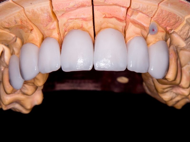 Faccette dentali: cosa sono e come funzionano